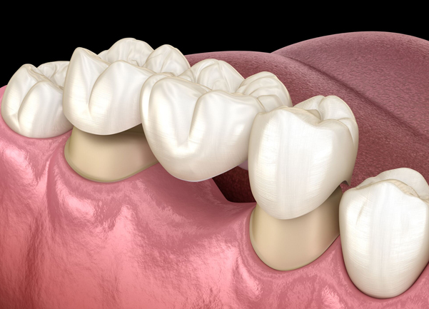 What Are Dental Bridges