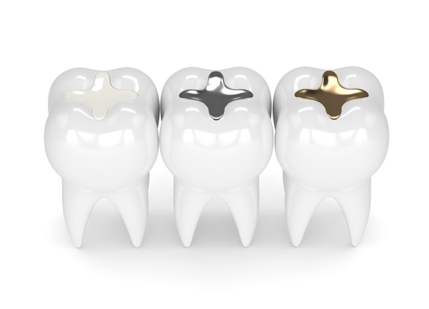 What Are Dental Fillings