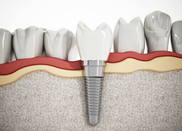 What Are Dental Implants