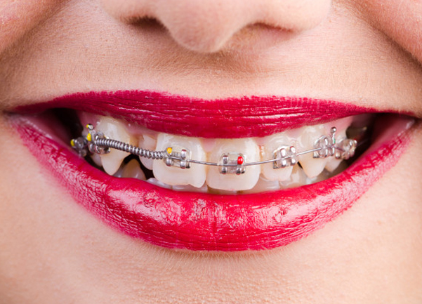 What Are Orthodontics