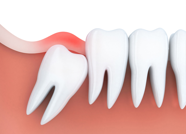 What Is Wisdom Teeth Removal