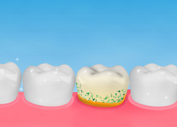 What Is A Periodontal Scaling And Root Planing