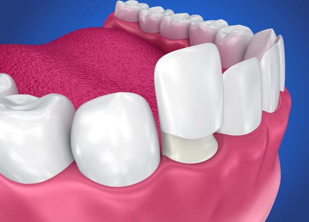 Why Might Dental Crowns Be Needed