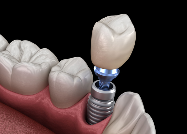 Why Might Dental Implants Be Needed