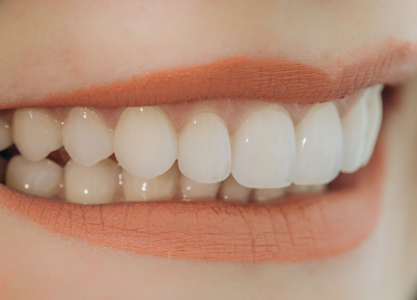 Why Might Porcelain Veneers Be Needed