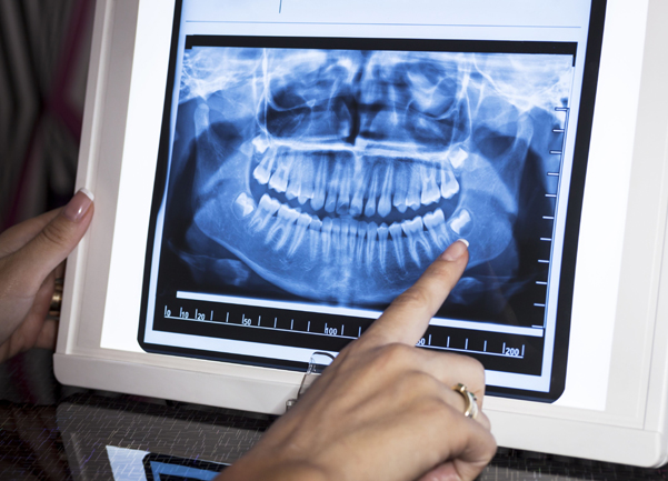 Why Would Dental X Rays Be Needed